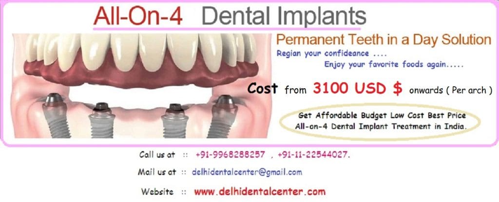 All-On-4 Dental Implants India