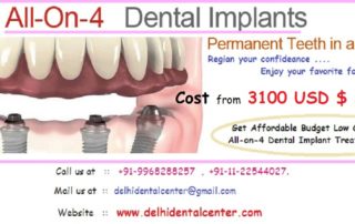 All-On-4 Dental Implants India