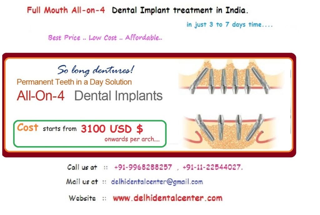 All on 4 dental implants india