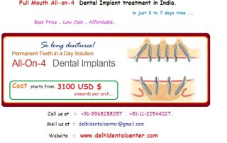 All on 4 dental implants india