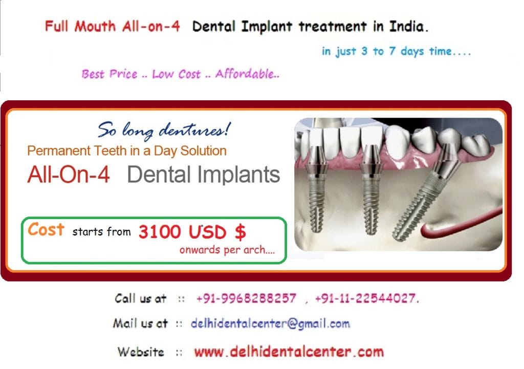 All on 4 dental implants india