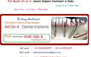 All on 4 dental implants india