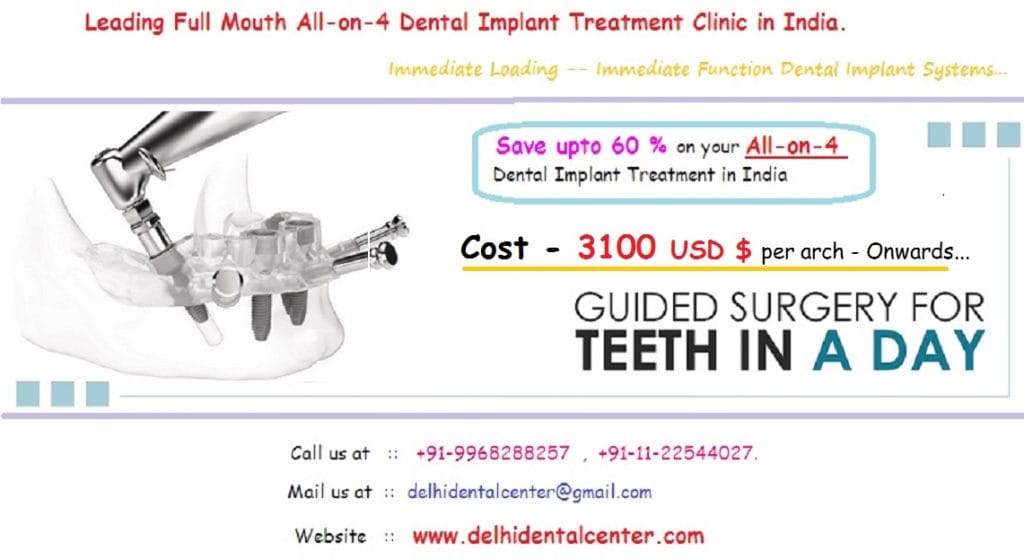 All on 4 dental implants india