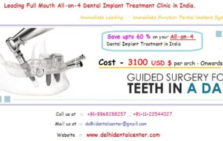 All on 4 dental implants india