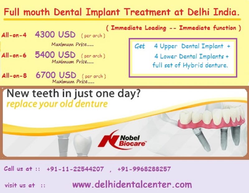 All on 4 dental implants india