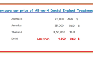 All-On-4 Dental Implants India