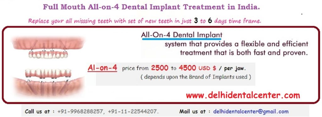 All-On-4 Dental Implants India