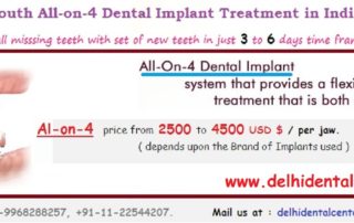 All-On-4 Dental Implants India