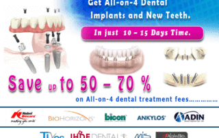 All on 4 Dental Implants