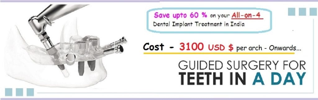 All-On-4 Dental Implants India