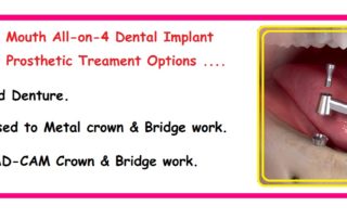 All-On-4 Dental Implants India