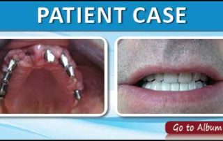 All-On-4 Dental Implants India