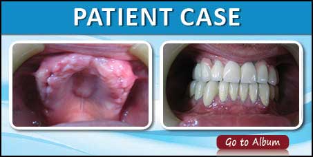 All-On-4 Dental Implants India