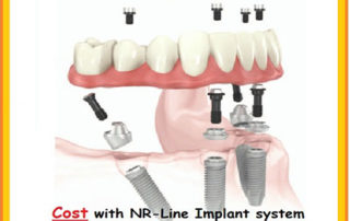 All-On-4 Dental Implants India