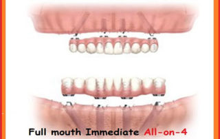 All-On-4 Dental Implants India