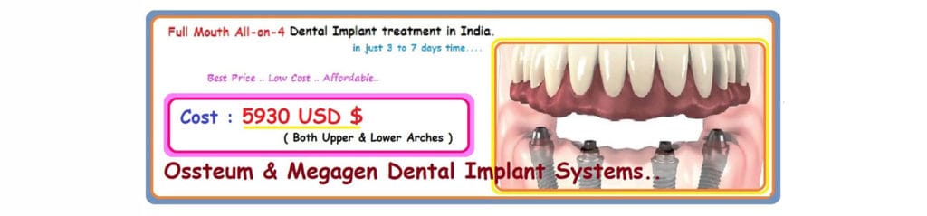 All-On-4 Dental Implants India