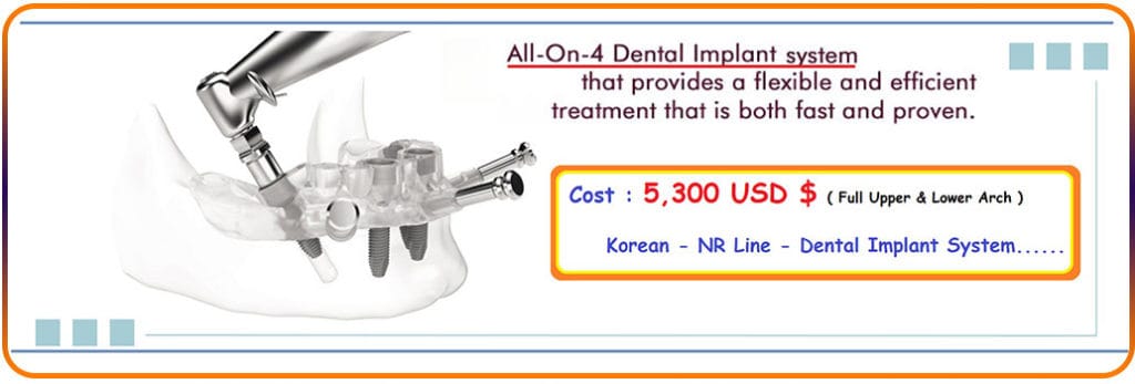 All-On-4 Dental Implants India