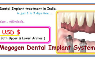 All-On-4 Dental Implants India