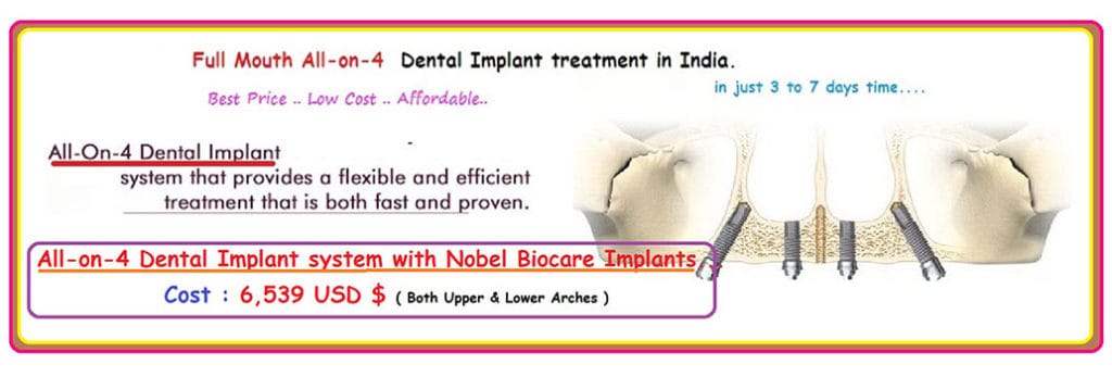 All-On-4 Dental Implants India