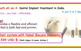 All-On-4 Dental Implants India