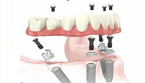 full mouth all-on-4 dental implant dentist clinic in India Delhi