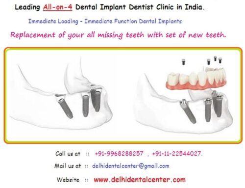 Best Top All-in-4, Dental Implants Abroad, Dental Tourism East Delhi, cheap dental implants abroad.