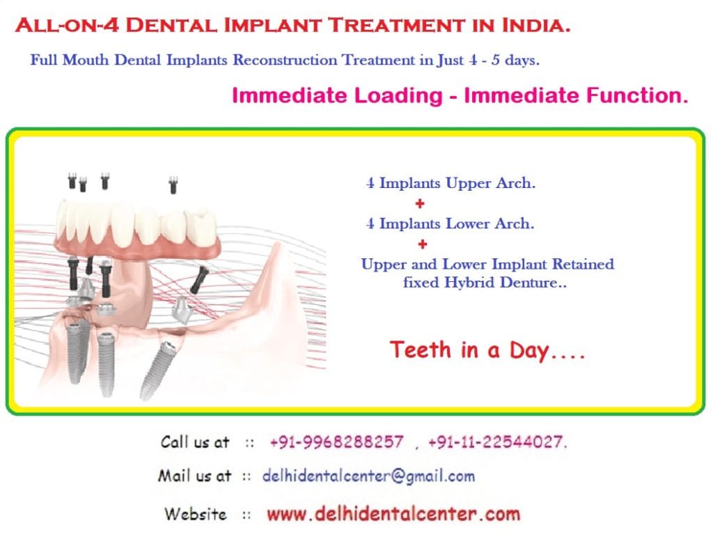 All on 4 Dental Implant