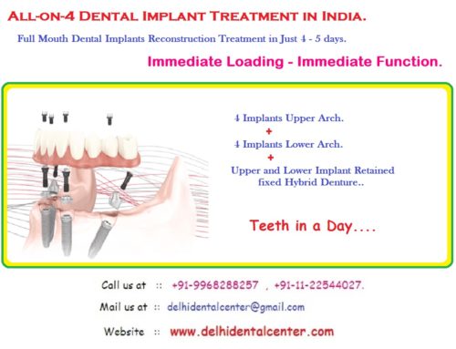 Assuming that everyone is suitable for All on 4 dental implants