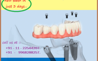 All on 4 Dental Implant