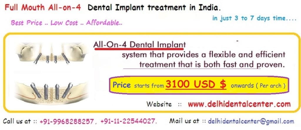 All on 4 Dental Implant