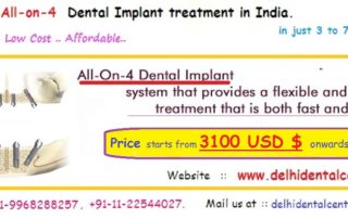 All on 4 Dental Implant