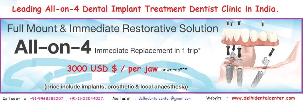 All on 4 Dental Implant