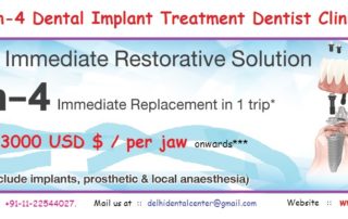 All on 4 Dental Implant