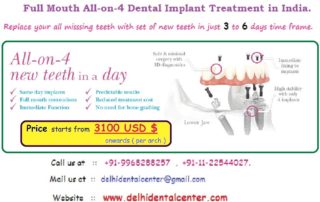 All on 4 Dental Implant