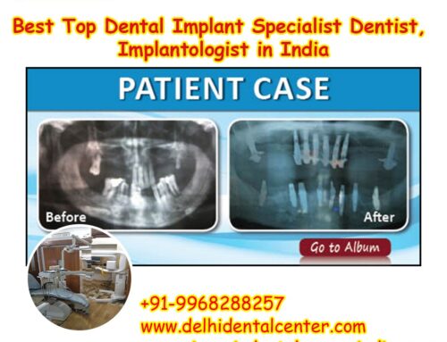 Best Top All-in-4, Dental Implant Clinic India.