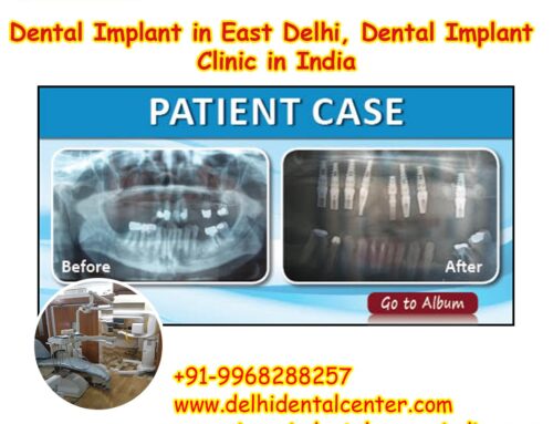 Best Top All-in-4, Best Top Leading Dental Implant Specialist Dentist in India