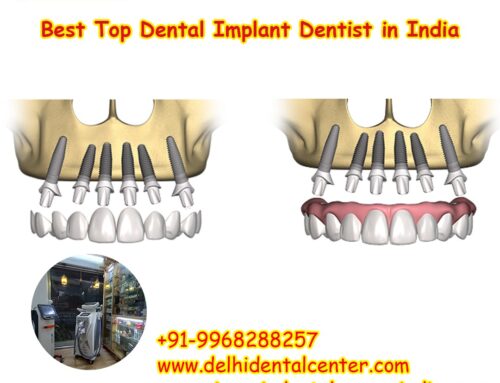 Best Top All-in-4, Best Top Painless Dental Implant surgery East Delhi.