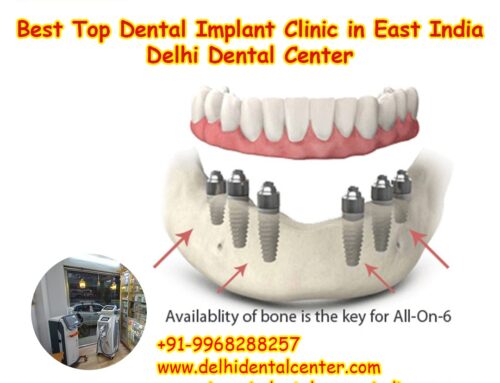 Best Top All-in-4, Dental Implants Abroad, Dental Tourism India, Dental Implant Tourism India.