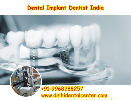 Best Top All-in-4, Dental Implant India