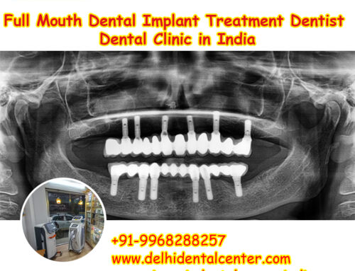 Best Top All-in-4, Full Mouth Dental Implant Treatment Dentist Dental Clinic in India.