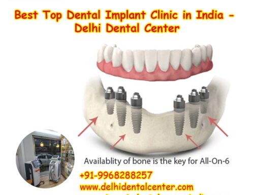 Best Top All-in-4, Best Top Dental Implant Clinic in India – Delhi Dental Center