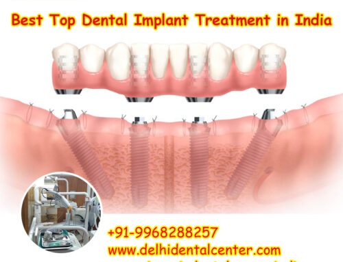 Best Top All-in-4, Best Top Dental Implant Treatment in India.