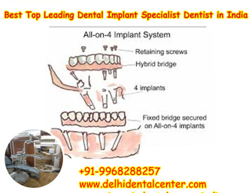 Best Top All-in-4, Best Top Leading Dental Implant Specialist Dentist in India,