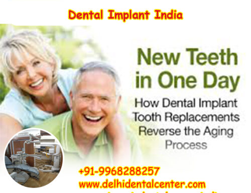 Best Top All-in-4, Dental Implant India,