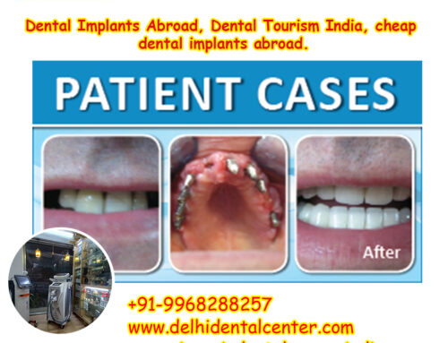 Best Top All-in-4, Dental Implants Abroad, Dental Tourism India, cheap dental implants abroad.