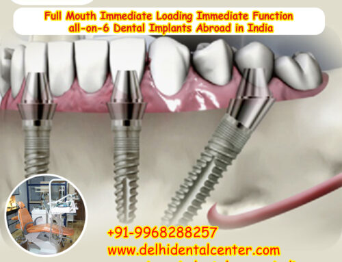 Best Top All-in-4, Full Mouth Immediate Loading Immediate Function all-on-6 Dental Implants Abroad in India.