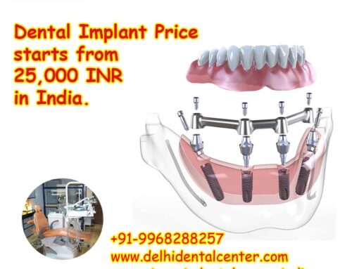 Best Top All-in-4, Dental Implant Price starts from 25,000 INR in India.